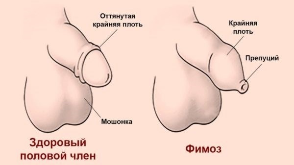 Фимоз: расписание болезней