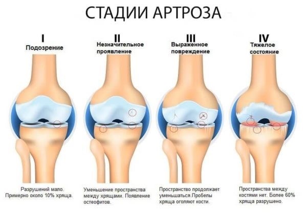 Ограничения, налагаемые артрозом в зависимости от локализации