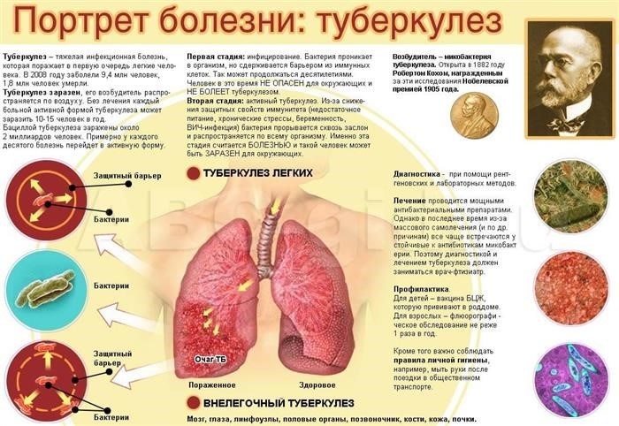 Можно ли работать с туберкулезом?