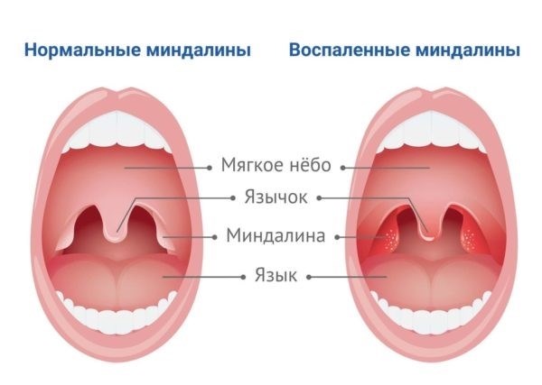 Хронический тонзиллит и армия